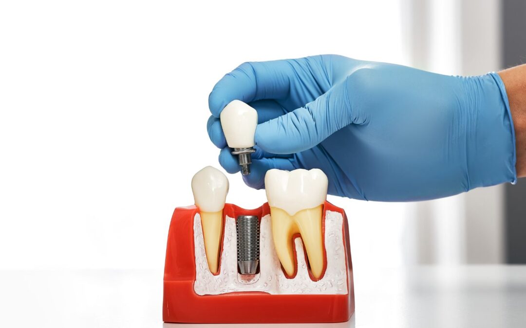 What’s the Process for Getting a Dental Implant in Oshawa?