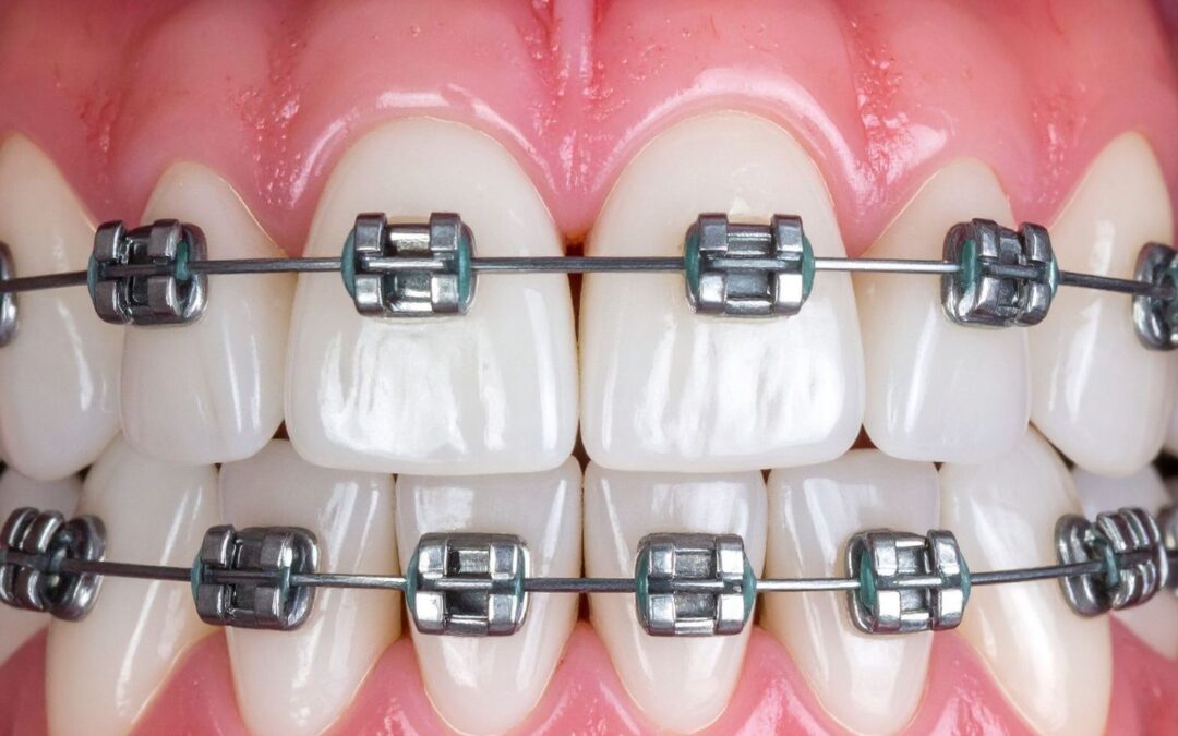 Advancements in Modern Orthodontics for a Confident Smile