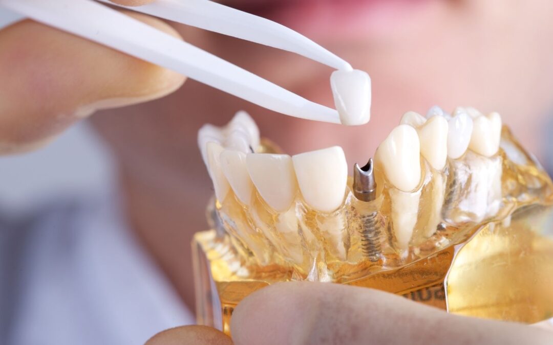 Dental Implants and Speech: What Changes to Expect and How to Adapt