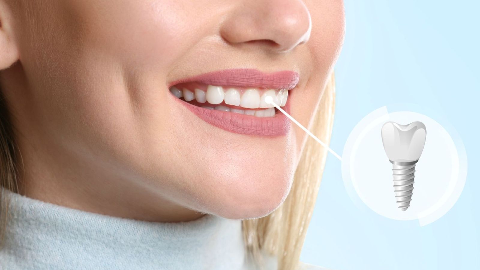 risk of peri-implantitis